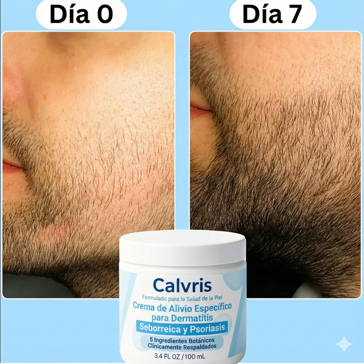 Crema para dermatitis seborreica y psoriasis